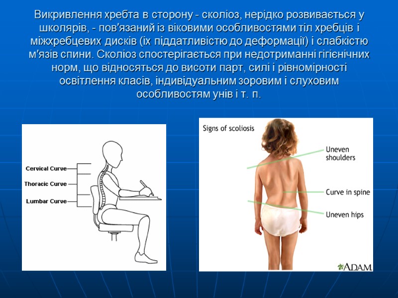 Викривлення хребта в сторону - сколіоз, нерідко розвивається у школярів, - пов′язаний із віковими